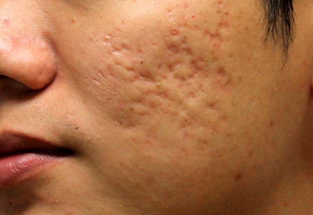 Treatment of Acne Scars