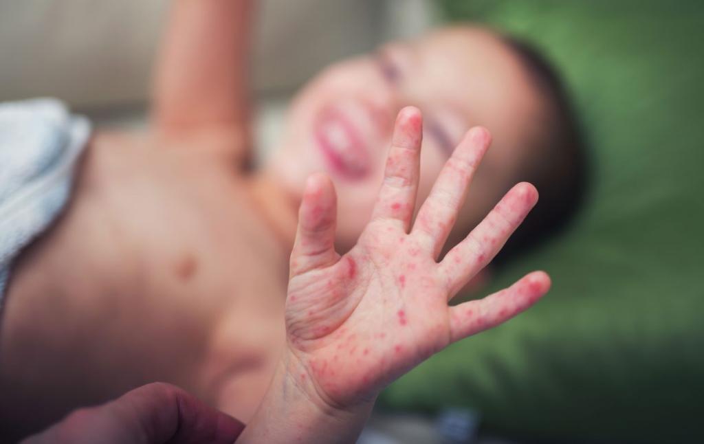 HAND - FOOT - MOUTH DISEASE 