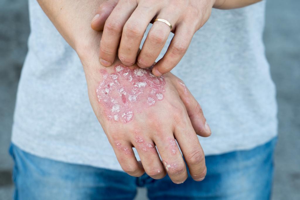 PSORIASIS 